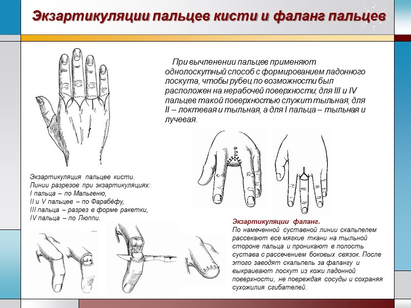 Экзартикуляции пальцев кисти и фаланг пальцев При вычленении пальцев применяют однолоскутный способ с формированием